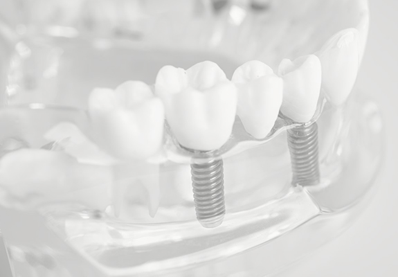 Dental Implants